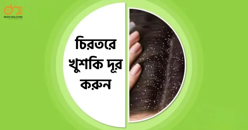 চিরতরে খুশকি দূর করুন