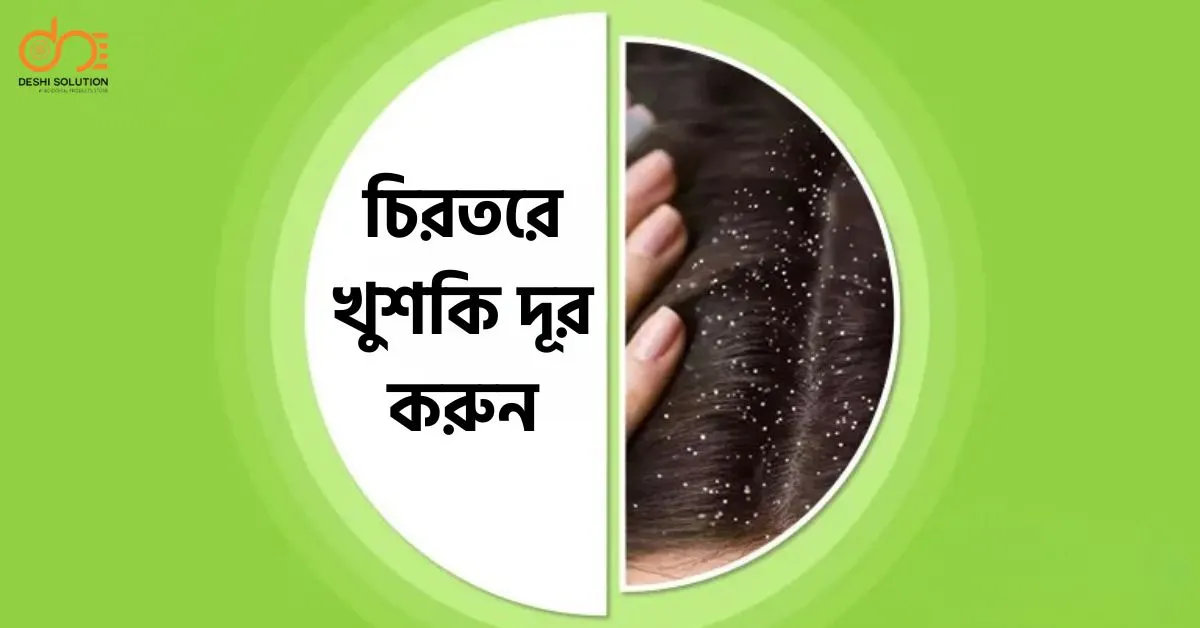 চিরতরে খুশকি দূর করুন: সহজ উপায় ও ঘরোয়া সমাধান!