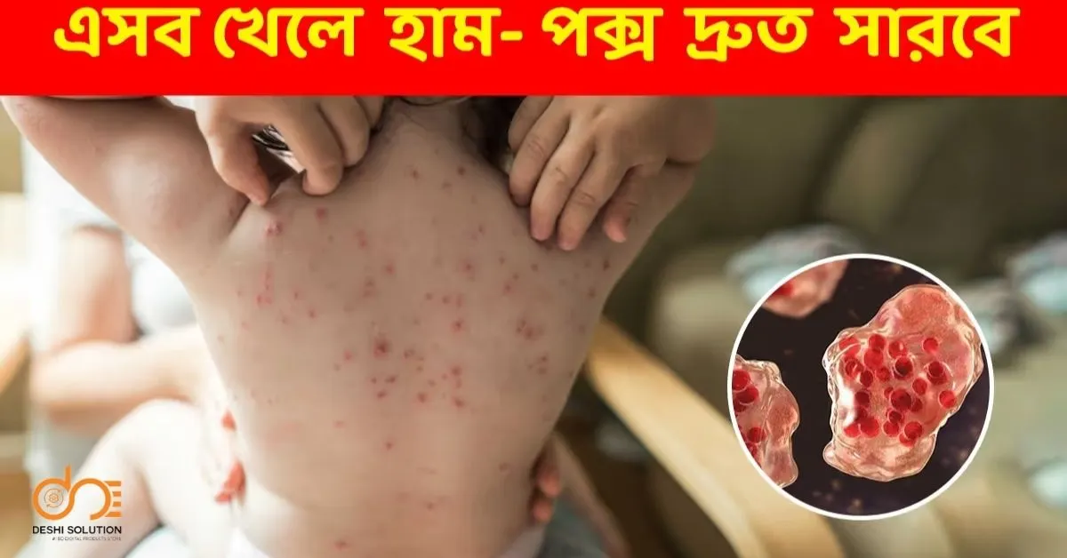 পক্স হলে কী খাবেন না? খাবার তালিকা ও জরুরি টিপস